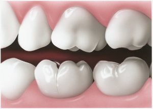 diagram of a cracked tooth 