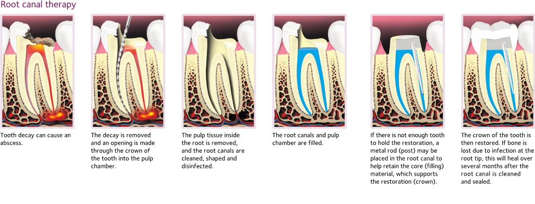 steps involved in a root canal