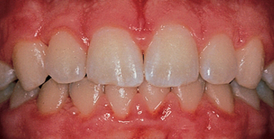 teeth and gums with gingivitis