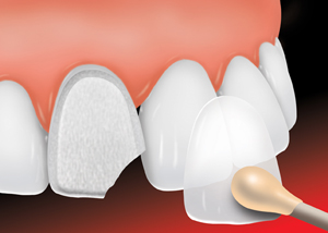 a ceramic veneer being placed on a chipped tooth