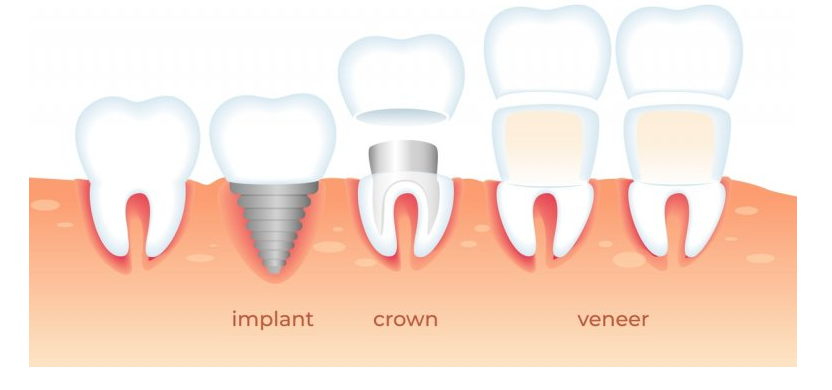 diagram of implant, crown and veneer