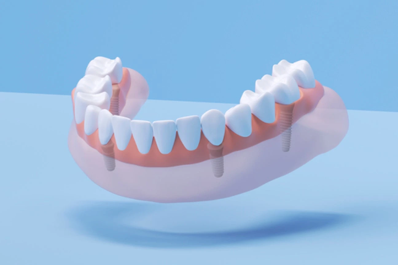 An illustration of a fixed full arch dental implants showcasing a fixed, full row of permanent teeth.