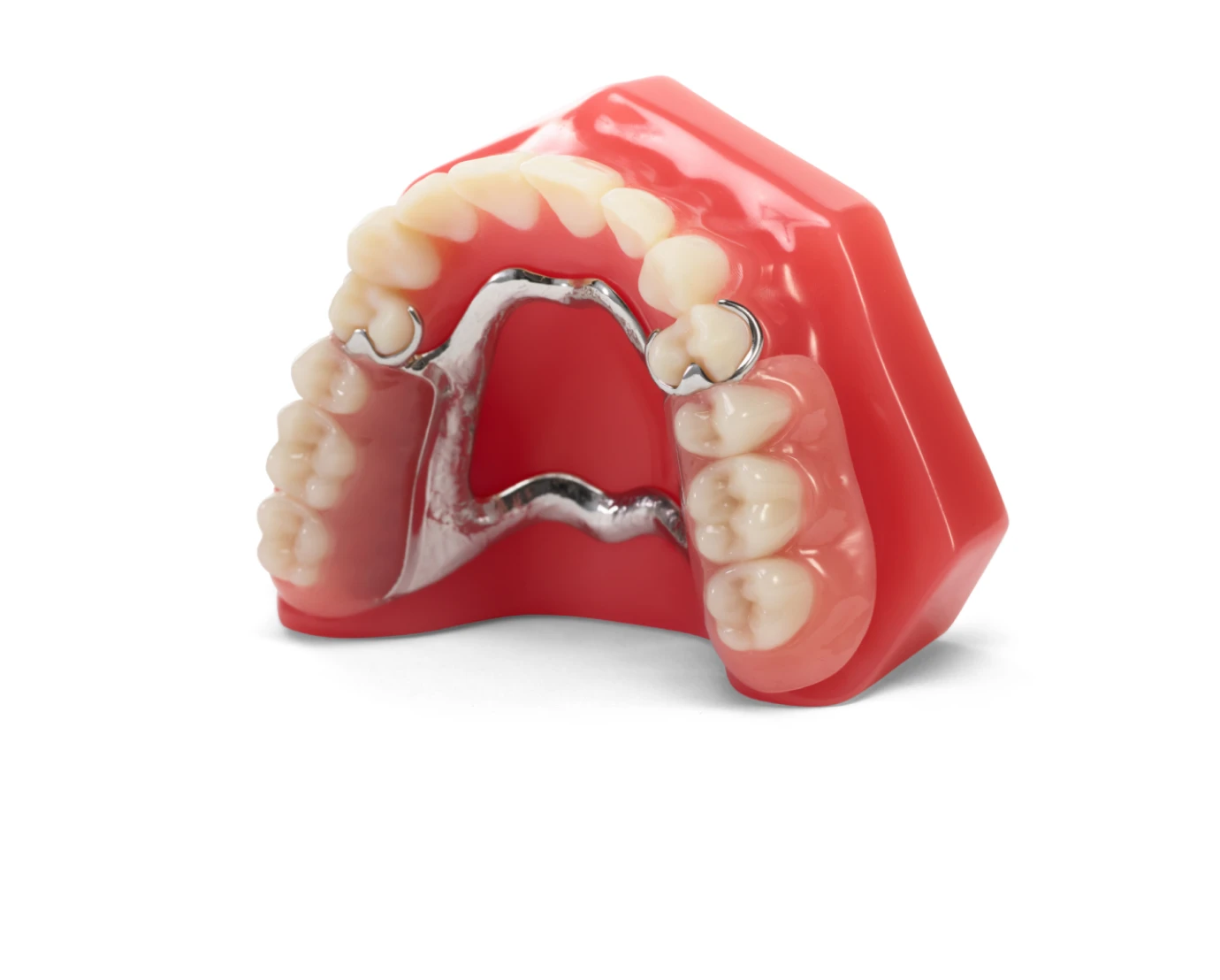 A model showcasing an upper partial denture with a pink base and metal framework for replacing missing teeth.
