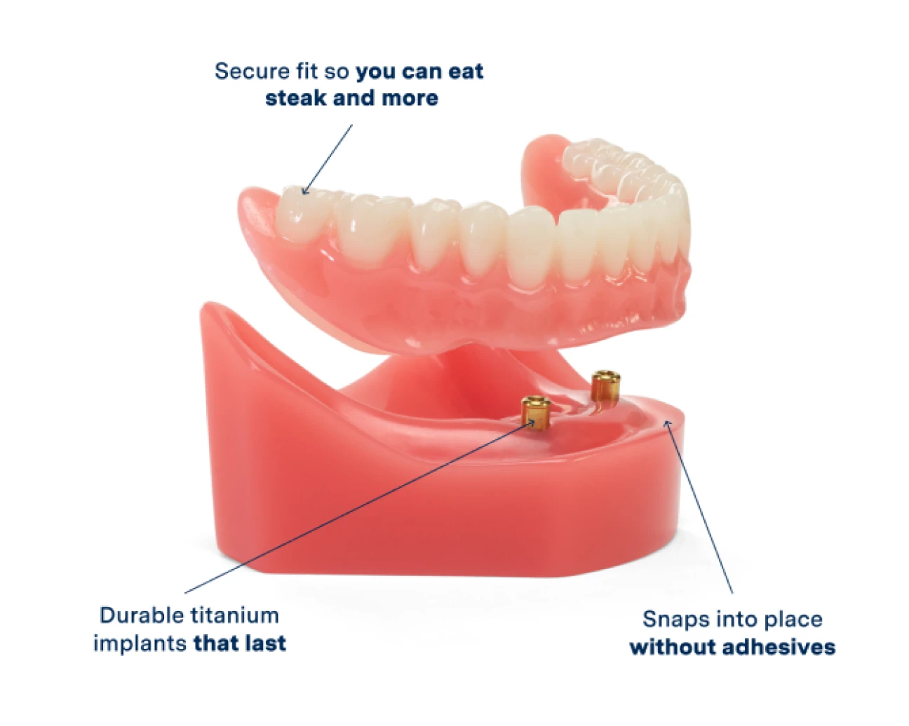 A model of implant dentures showcasing the features:
3x stronger bite than conventional dentures
snaps into place without adhesives, and 
A lasting titanium implant for a comfortable fit