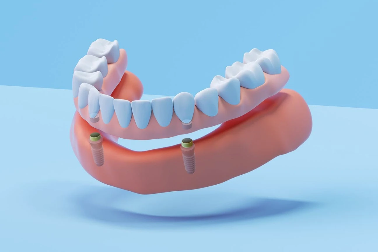  An illustration of a lower arch of dentures above dental implants showcasing implant dentures.
